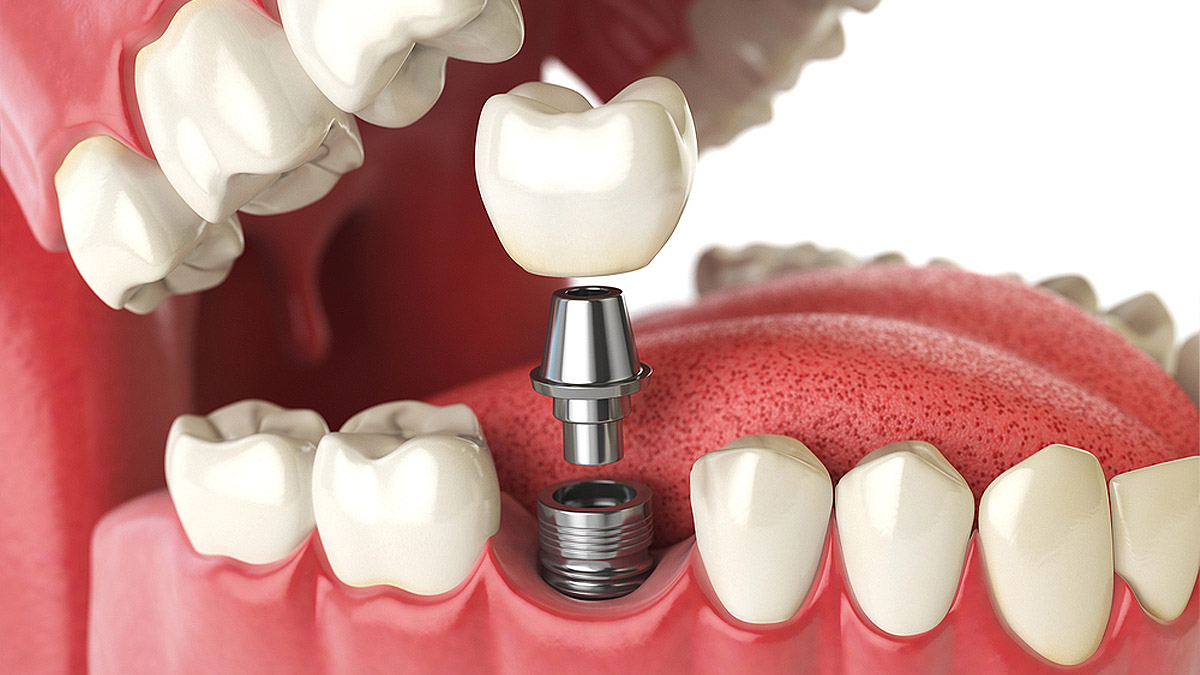 Зубная имплантация в стоматологии Estellika - Люблино