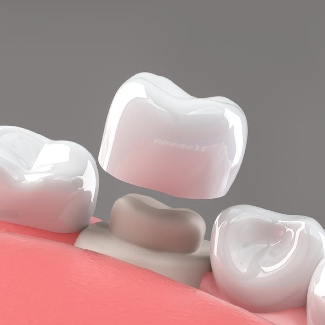 dental crowns in saudia arabia